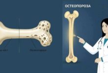 Остеопорозата – „тихият крадец“, измерват костната плътност в областта
