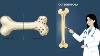 Остеопорозата – „тихият крадец“, измерват костната плътност в областта